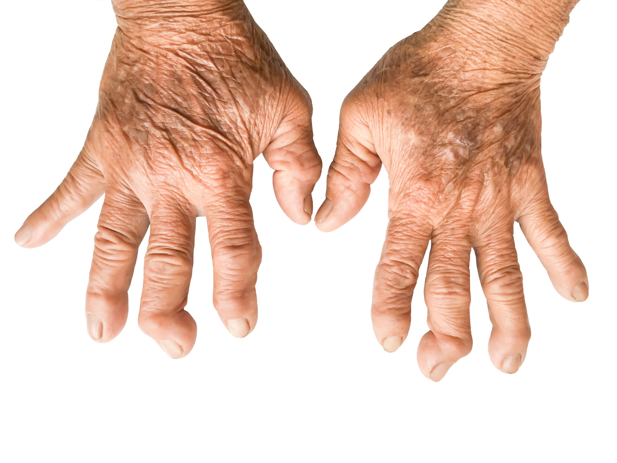 Rheumatoid Arthritis Dengan Biomedical Treatment